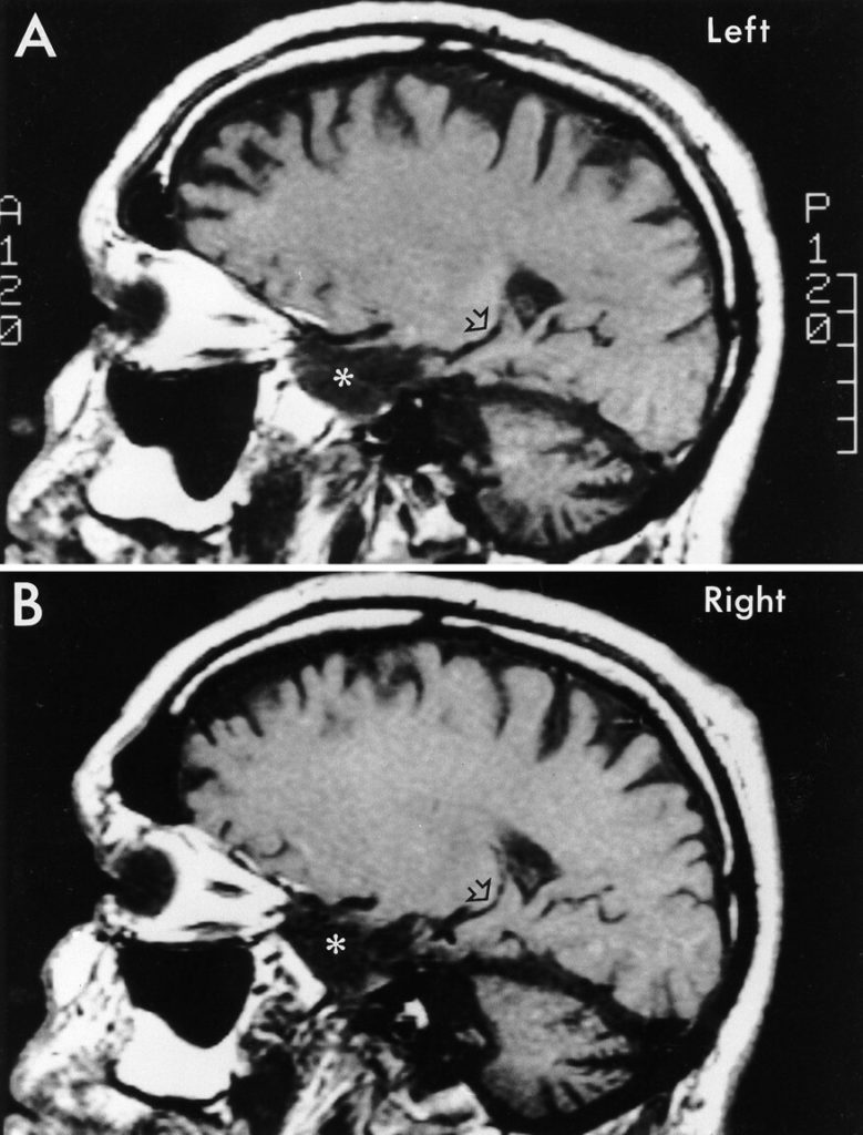 Deux photographies issues d’un examen par IRM. Sur les deux, le cerveau est visible en coupe sagittale avec le front à gauche et l’arrière de la tête à droite. 